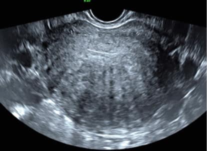 子宮內膜異位症不一定影響懷孕！慢工出細活的子宮大肌腺瘤二胎成功經驗分享！