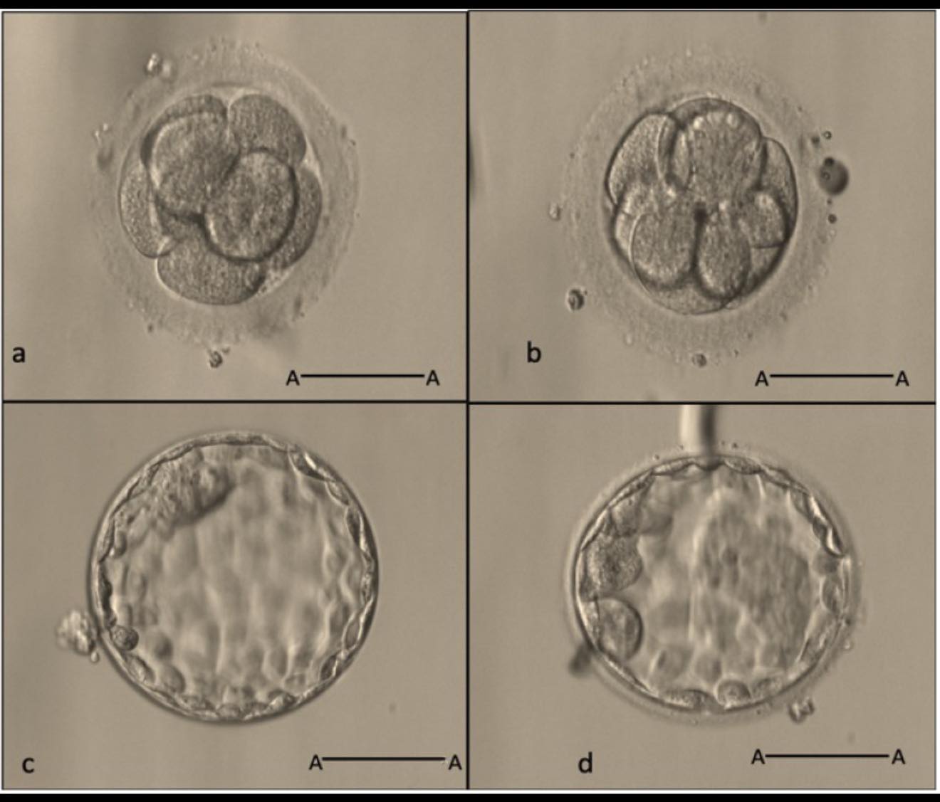 在沒有足夠的卵子或受精卵，D3 embryo transfer比D5 embryo transfer的優點？ #北醫生殖中心 的經驗談