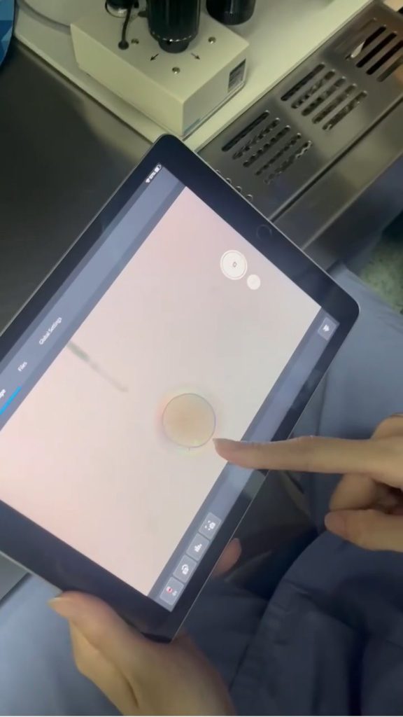 ICSI受精的卵子看的到紡錘體，就不會破壞到…..