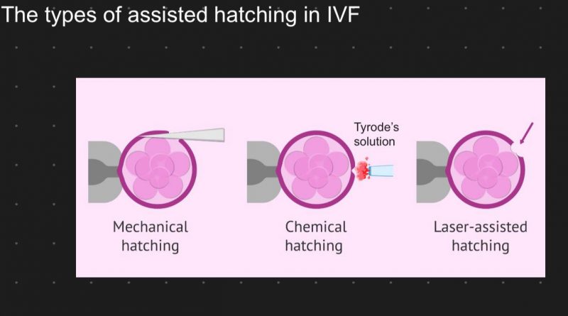 輔助胚胎孵化（Assisted Hatching)之於著床